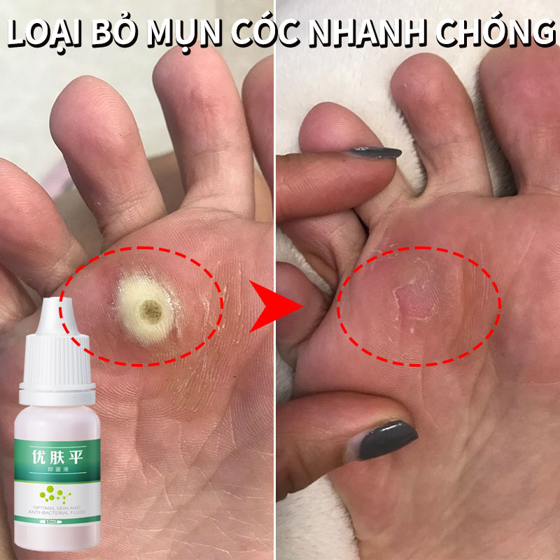 Kem tẩy mụn cóc Kem tẩy nốt ruồi Loại bỏ mụn cóc nhanh chóng 10ml An toàn không đau Nốt ruồi Mụn xoắn Mụn thường Mụn cám