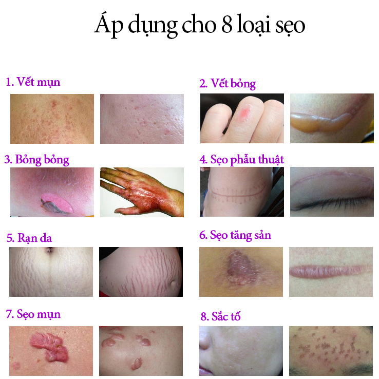 kem bôi sẹo kem mờ sẹo thâm scargel 30g vết thương sau phẫu thuật, vết rạn da tăng sản sẹo
