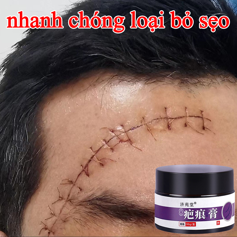 kem bôi sẹo kem mờ sẹo thâm scargel 30g vết thương sau phẫu thuật, vết rạn da tăng sản sẹo