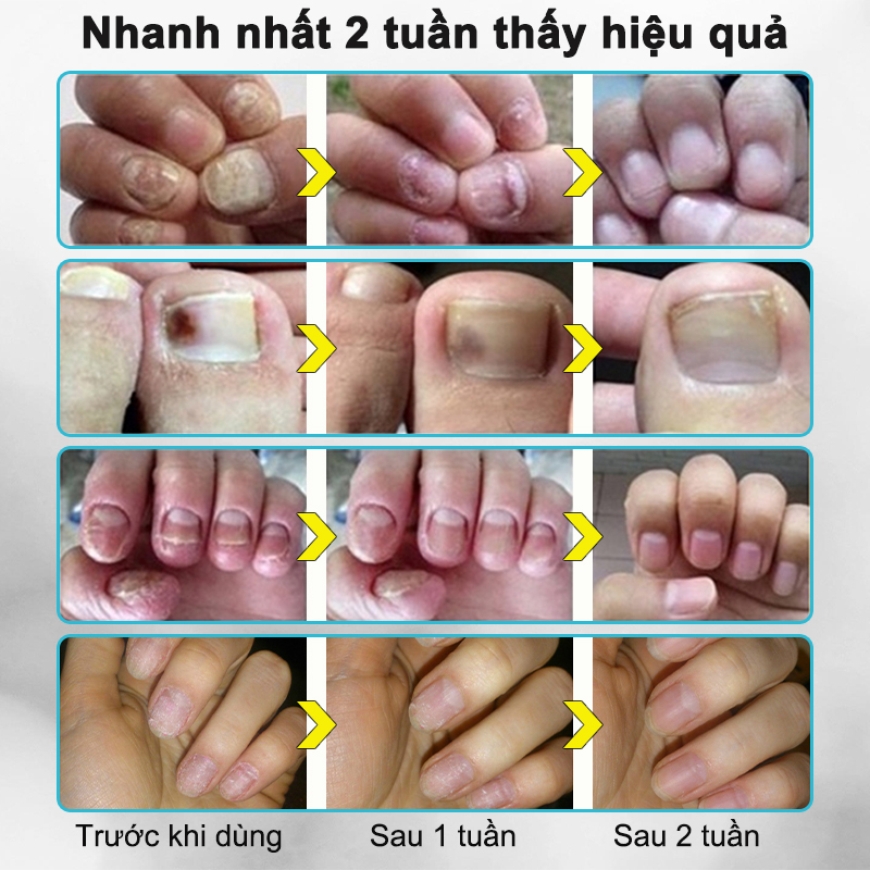 Kem nấm móng tay dưỡng móng tay thảo dược kháng khuẩn serum phục hồi móng chăm sóc chân 20ml