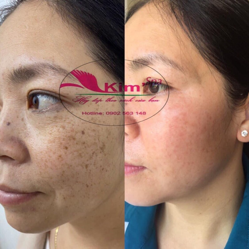 Kem Tái Tạo Bong Da Đông Y Xoá Mụn Nám Tàn Nhang Cao Cấp Chuẩn Spa