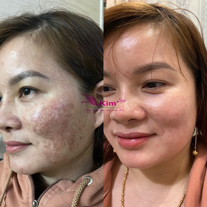 Kem Tái Tạo Bong Da Đông Y Xoá Mụn Nám Tàn Nhang Cao Cấp Chuẩn Spa