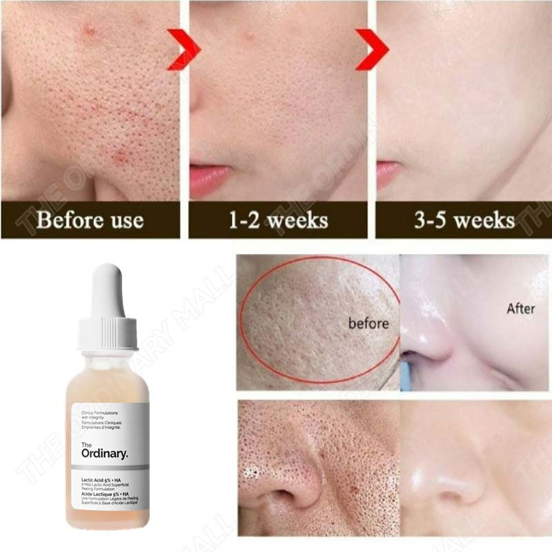 Serum the Ordinary Tẩy Da Chết Mụn Đầu Đen Tinh Chất Lactic Acid 10% + HA Mực Toner
