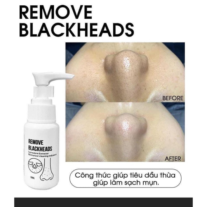 Ủ mụn đầu đen Remove Blackheads 50ml chính hãng