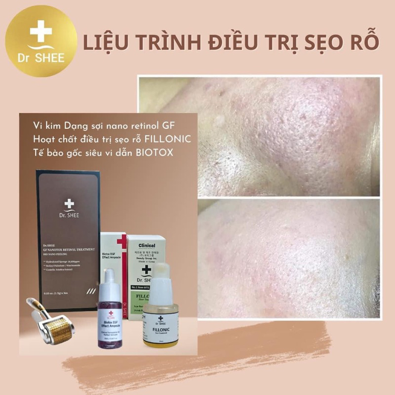 Liệu trình làm đầy sẹo rỗ (Fillonic) 20ml mẫu mới