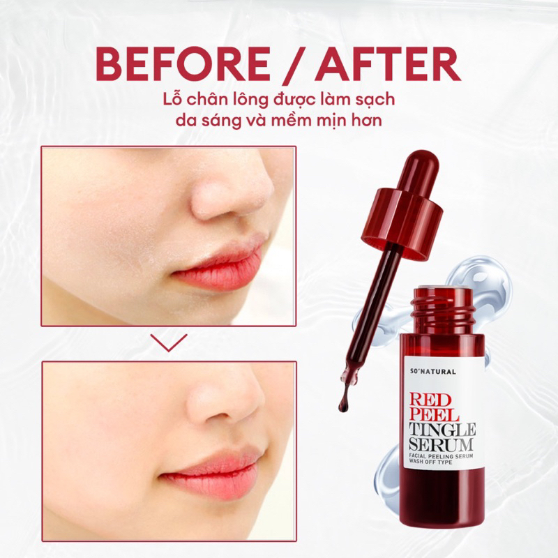 Tinh Chất Peel Da Sinh Học So’Natural Red Peel Tingle Serum - 11ml Mẫu Mới