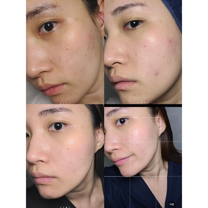 TINH CHẤT DƯỠNG SÁNG DA ISOI BLEMISH CARE SERUM 35ML