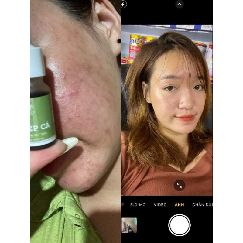 SERUM MỤN DIẾP CÁ THIÊN NHIÊN - CẢI THIỆN SAU 7 NGÀY  - SERUM DIẾP CÁ IGREEN