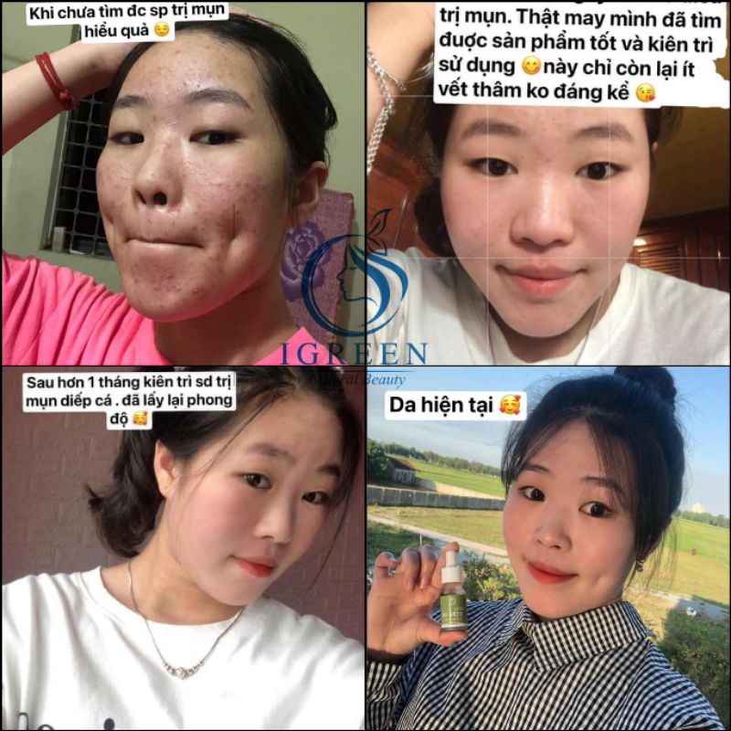 SERUM MỤN DIẾP CÁ THIÊN NHIÊN - CẢI THIỆN SAU 7 NGÀY  - SERUM DIẾP CÁ IGREEN