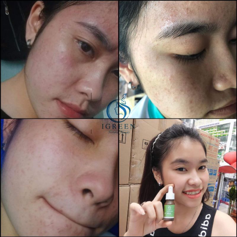SERUM MỤN DIẾP CÁ THIÊN NHIÊN - CẢI THIỆN SAU 7 NGÀY  - SERUM DIẾP CÁ IGREEN