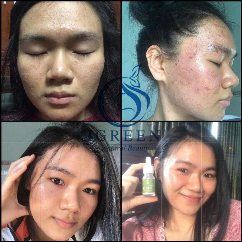 SERUM MỤN DIẾP CÁ THIÊN NHIÊN - CẢI THIỆN SAU 7 NGÀY  - SERUM DIẾP CÁ IGREEN