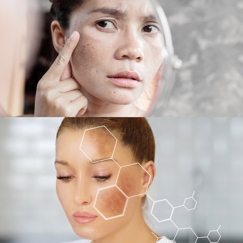 Bộ kem làm sạch nám bong tế bào nám