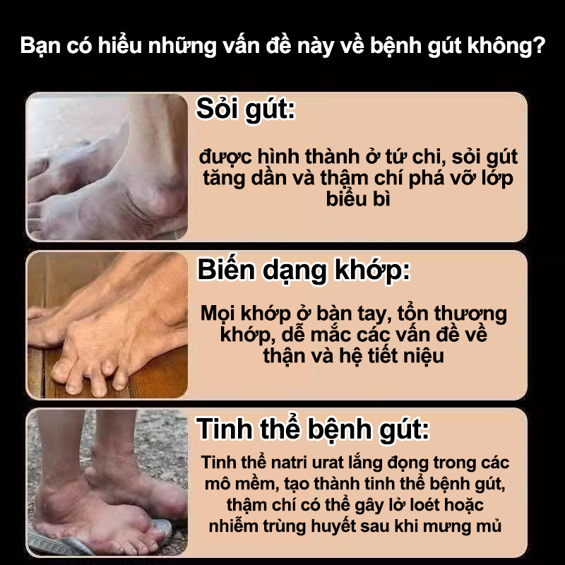 Kem bệnh gout giảm nhẹ sưng khớp đau khớp Hạ axit uric Hòa tan hạt tophi đau đầu gối Giảm sưng Giảm đau 35g