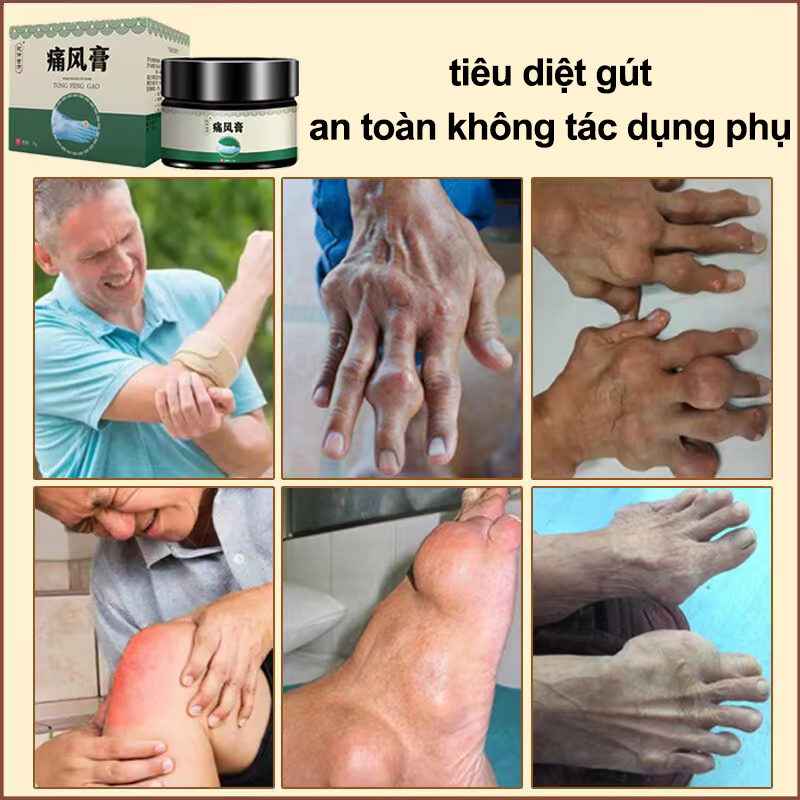 Kem bệnh gout giảm nhẹ sưng khớp đau khớp Hạ axit uric Hòa tan hạt tophi đau đầu gối Giảm sưng Giảm đau 35g