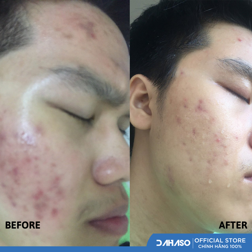 Gel Ezanic 20% Giảm Thâm đỏ, thâm nâu, ngăn ngừa mụn 15g - Dahaso Skin