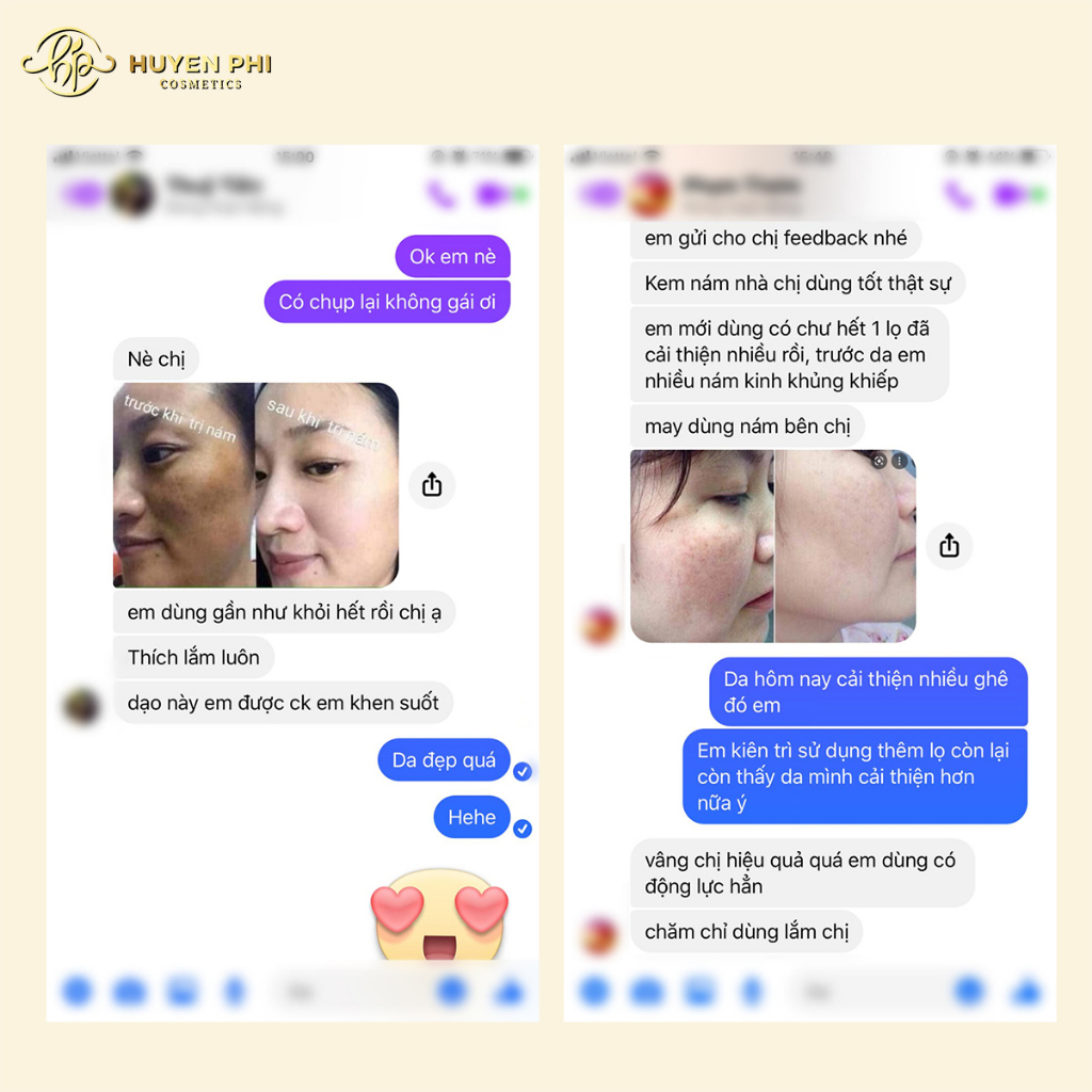 Kem Nám Melasma Perfect Extra - Dưỡng da, ngăn ngừa, làm mờ vết nám - tàn nhang