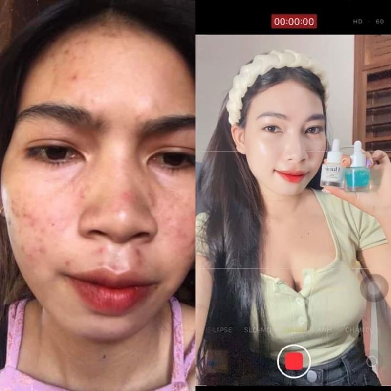 COMBO SERUM HUNIE MẪU MỚI 25ML