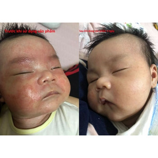 Kutieskin 30gr Dành Cho Da Em Bé Bị Chàm Sữa
