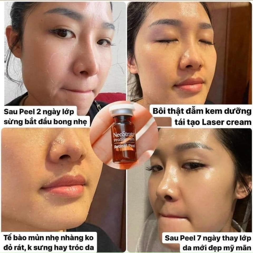 1 Lọ tinh chất thay da sinh học Neostra Retinol Peel 1.5 ml