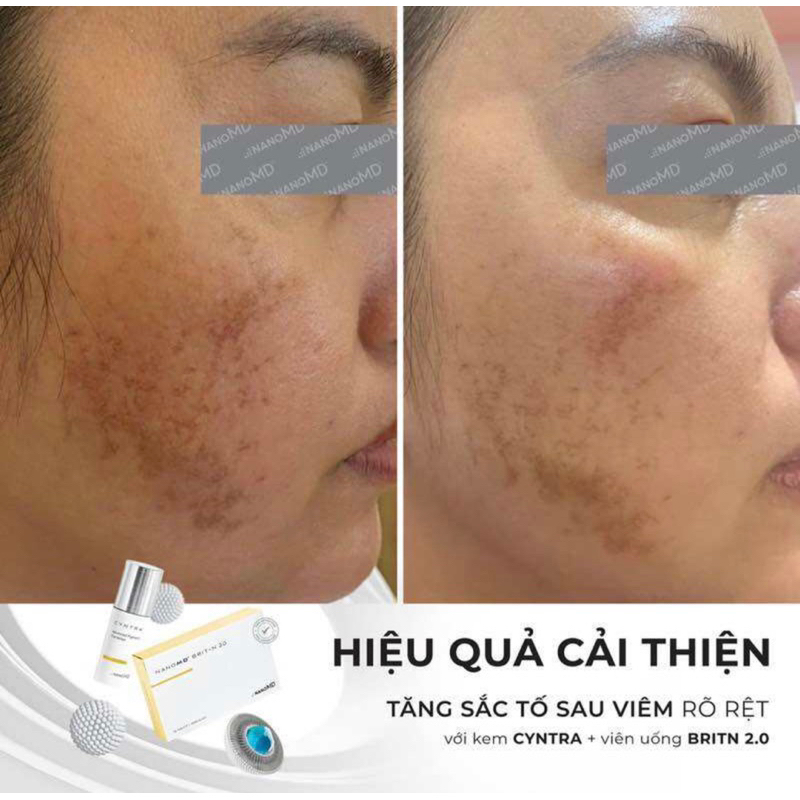 Kem NanoMD xoá tan thâm nám tàng nhang hiệu quả sau 1 liệu trình