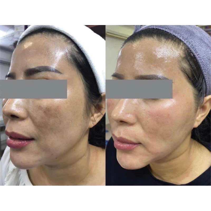 Kem NanoMD xoá tan thâm nám tàng nhang hiệu quả sau 1 liệu trình
