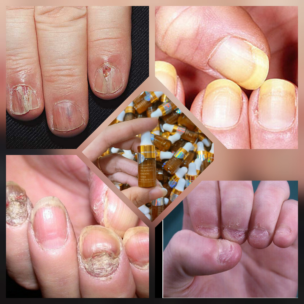 Combo 5 chai serum đánh bay nấm móng, bọng móng, hư khóe, nước ăn tay chân, phục hồi móng hư tổn
