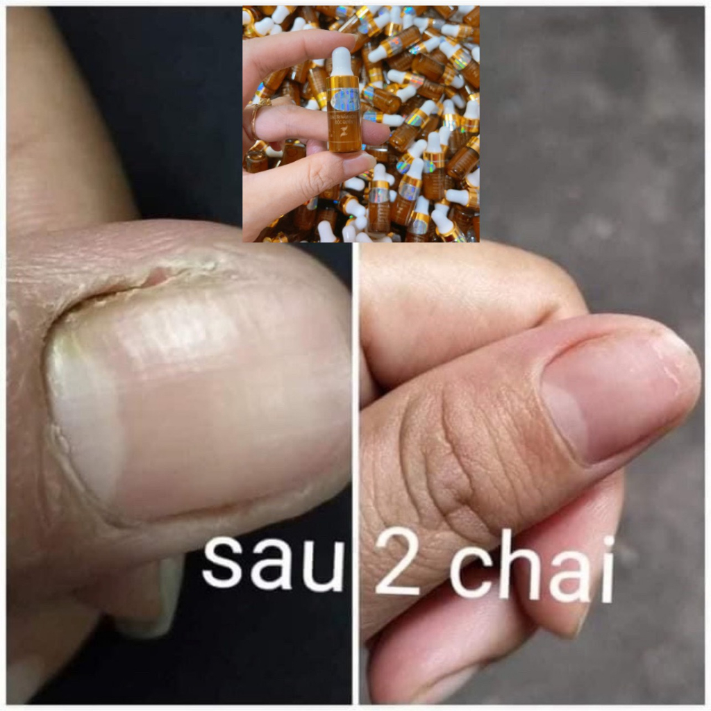 Combo 5 chai serum đánh bay nấm móng, bọng móng, hư khóe, nước ăn tay chân, phục hồi móng hư tổn