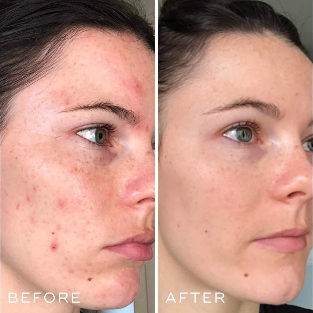 Serum phục hồi cấp ẩm Medik8 Hydr8 B5 Liquid Rehydration Serum 60ml làm dịu da mặt / Subeo Beauty