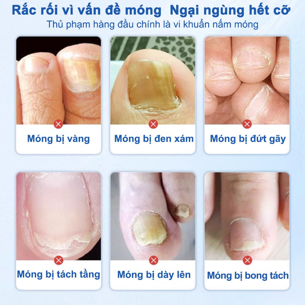 Kem nấm móng tay dưỡng móng tay thảo dược kháng khuẩn serum phục hồi móng chăm sóc chân 20ml