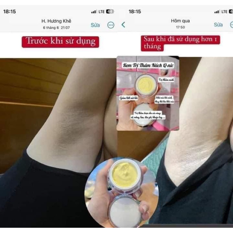 KEM TRi THÂM NÁCH VÀ BIKINI QNIC thái lan Mẫu mới