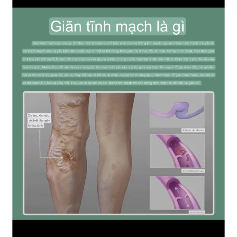 Kem Bôi Suy Giãn Tĩnh Mạch Ngăn Tái Lại - Giảm Đau Nhức, Tăng Cường Lưu Thông, Ngừa Chuột Rút (20g)