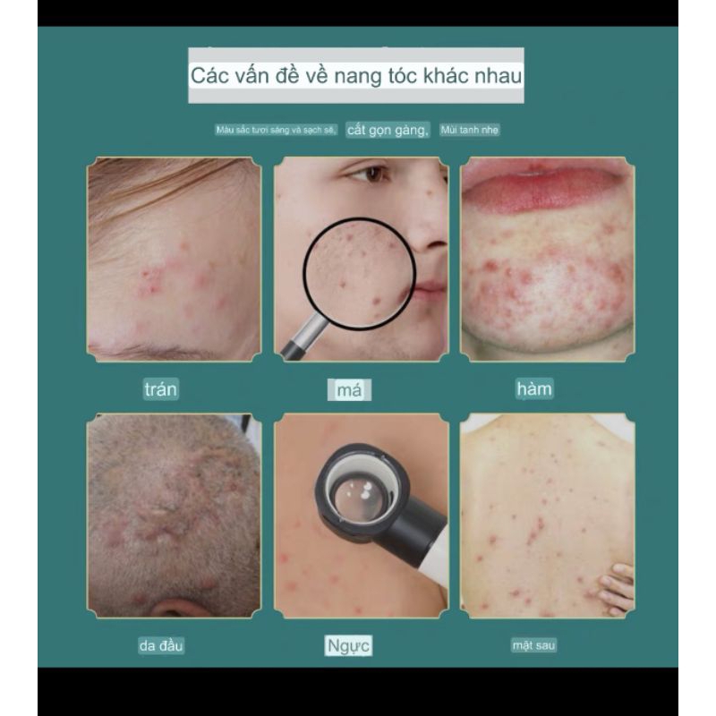 Kem Viêm Da Cơ Địa, Viêm Nang Lông MAO NANG YAN - Giảm Ngứa, Khắc Phục Dứt Điểm, Ngăn Tái Phát (30g)