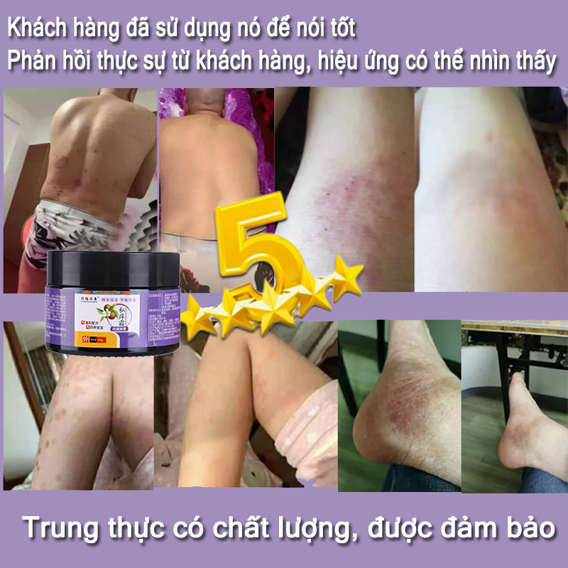Chăm sóc vùng kín Kem  Kem giảm ngứa 30g Chống nấm chống ngứa Da sử dụng bên ngoài các bộ phận riêng tư có thể được sử