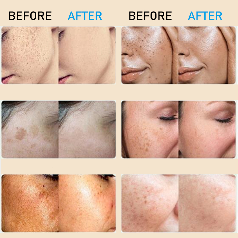 Kem nám tàn nhang kem đặc chấm tàn nhang nám tàn nhang 20g Loại bỏ các đốm đen sâu làm sáng trắng da