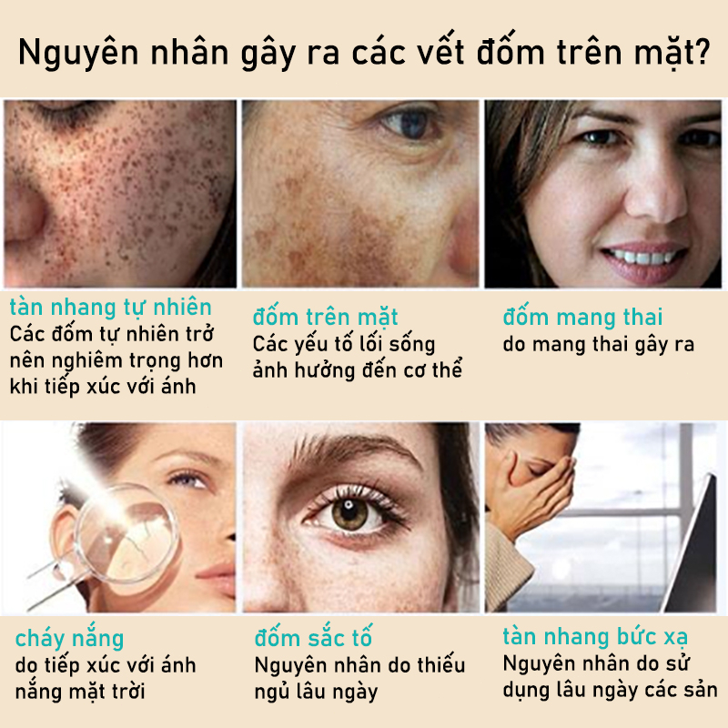 Kem nám tàn nhang kem đặc chấm tàn nhang nám tàn nhang 20g Loại bỏ các đốm đen sâu làm sáng trắng da