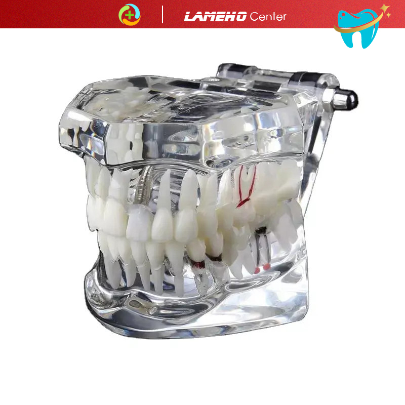 Mẫu hàm tư vấn nha khoa, mô hình tư vấn sâu răng, cắm implant, sâu răng DN42