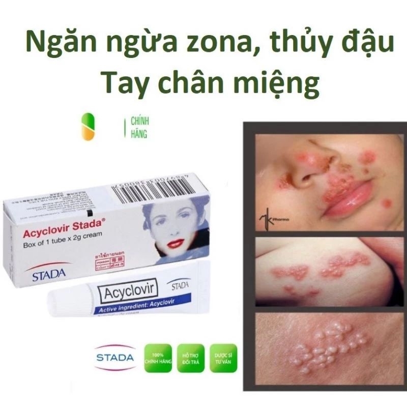 Kem bôi da Acyclovim ngăn ngừa zona.mịn rộp.sinh dục.mụn rộp môi sau khi phun