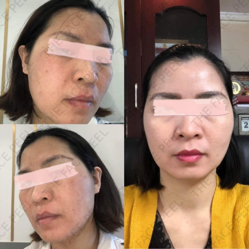 Kem tái tạo da the face peel