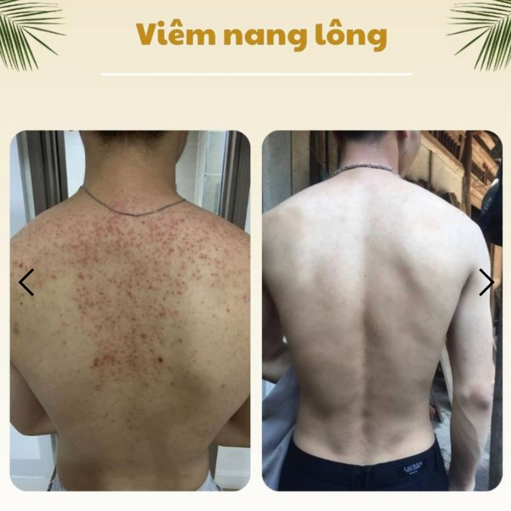 Tinh chất tắm dược liệu CLEAN, Chặn mụn ngăn thâm, Không lo tái phát, Dung tích 500ml - XAVIA COSMETICS