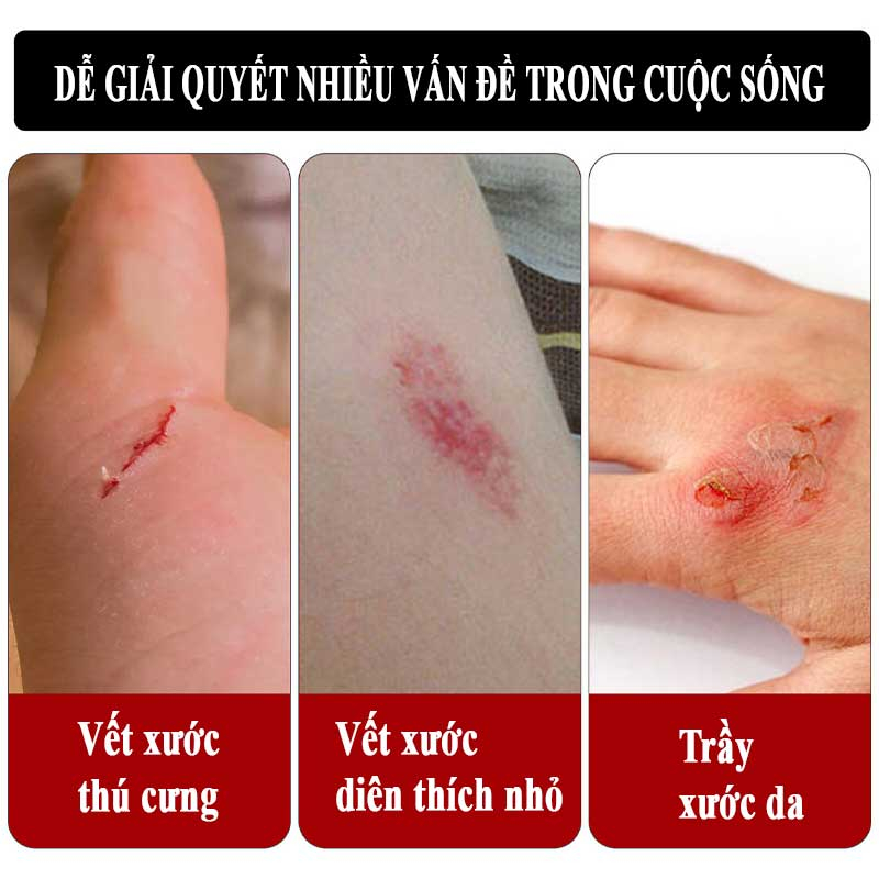 Xịt vết thương ITANA  giúp nhanh lành vết thương, hạn chế nhiễm trùng, sơ cứu vết bỏng, vết loét