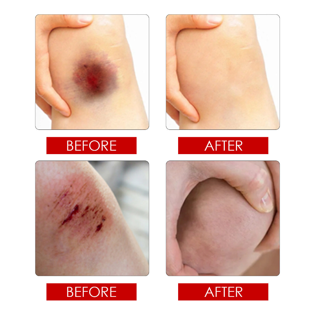 Xịt vết thương ITANA  giúp nhanh lành vết thương, hạn chế nhiễm trùng, sơ cứu vết bỏng, vết loét