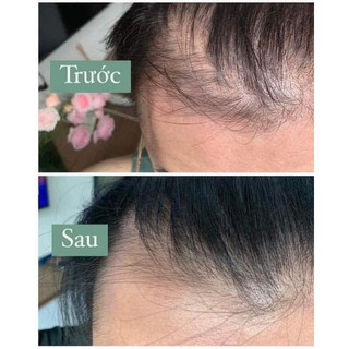 Xịt Mọc Tóc Minoxidil 5% - Giảm Rụng Tóc , Kích Mọc Tóc