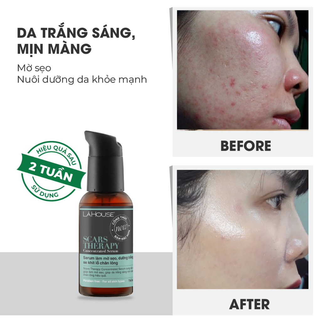 Serum dưỡng trắng da,làm mờ sẹo,se khít lỗ chân lông Lá House Scars Therapy Concentrated 15ml/30ml