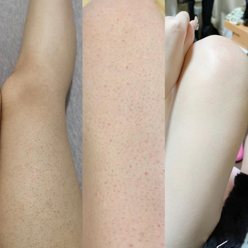 Combo trắng da retinol