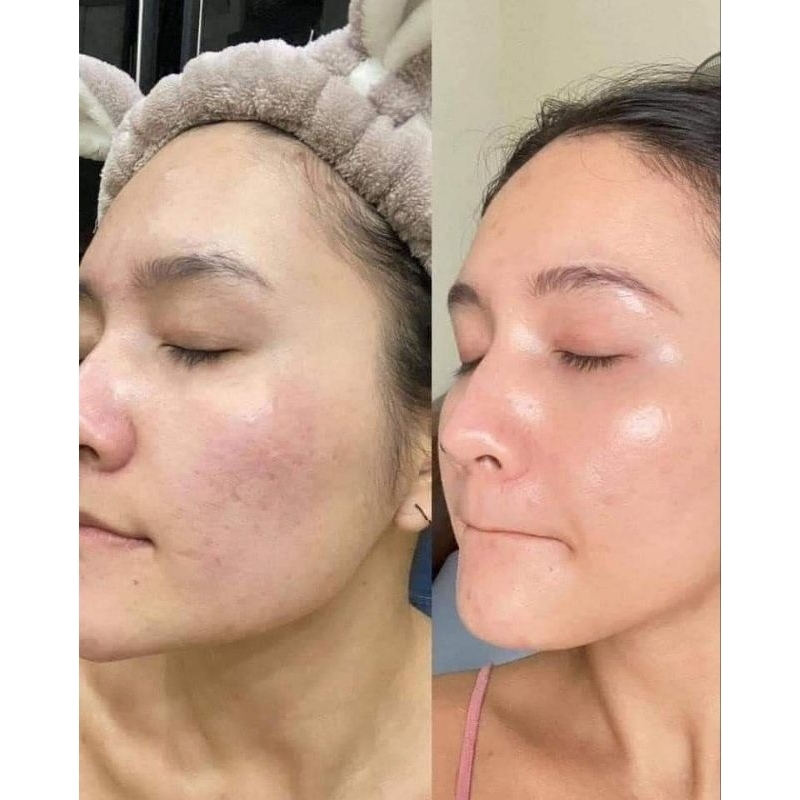 Dung dịch tẩy tế bào chết B.H.A 30ml, 50ml, 148ml