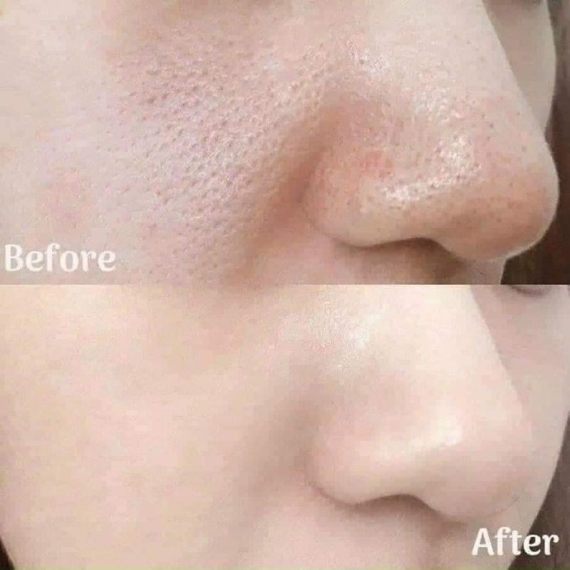 Dung dịch tẩy tế bào chết B.H.A 30ml, 50ml, 148ml