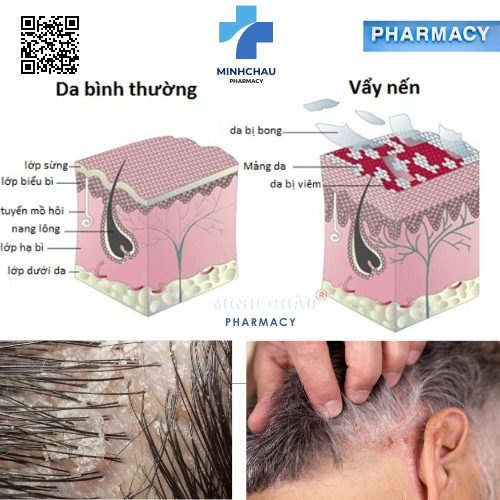 Crederm lotion 40 ml - Kem dưỡng chăm sóc da Chàm, Vẩy nến, Nấm da đầu, công thức Beprosalic lotion.