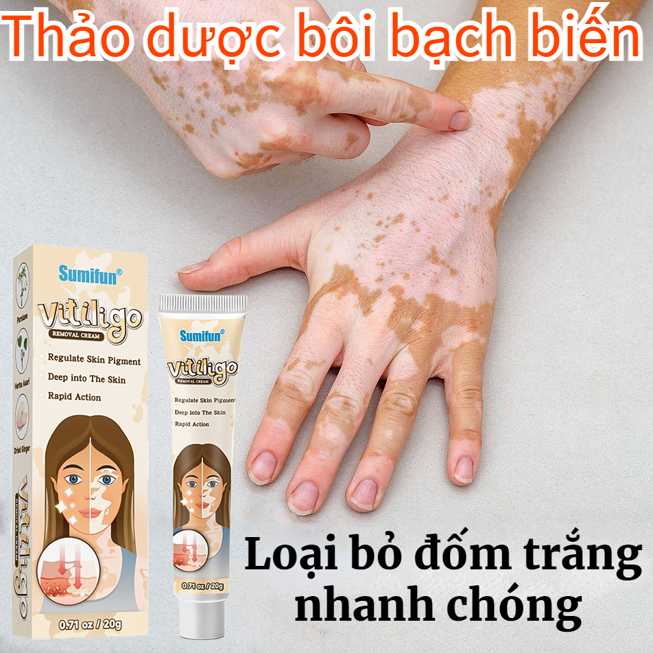 Kem bôi bạch biến Mỡ Điều Bạch Biến Thảo dược bôi bạch biến 20g Loại bỏ đốm trắng nhanh chóng Làm Đều Màu Da Sửa