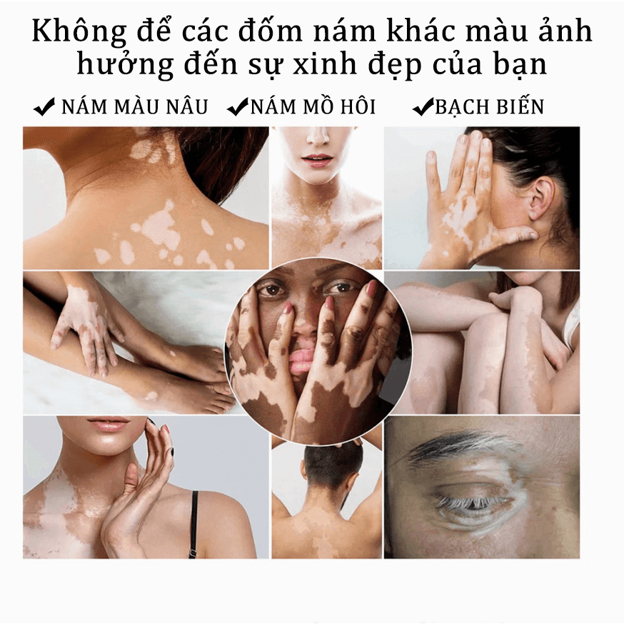 【HCM】Kem bôi bạch biến Mỡ Điều Bạch Biến Thảo dược bôi bạch biến 20g Loại bỏ đốm trắng nhanh chóng Làm Đều Màu Da Sửa