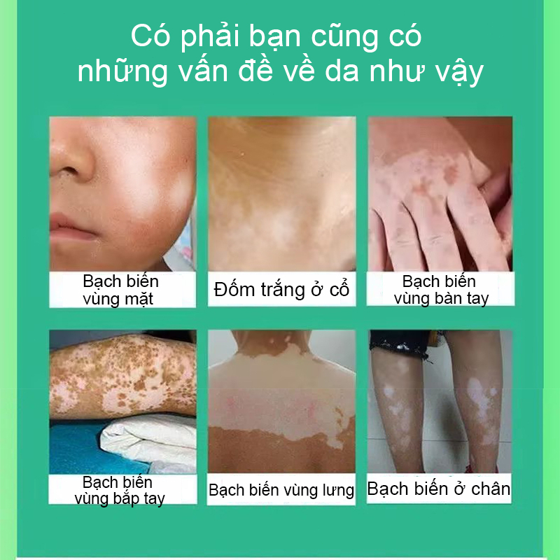 【HCM】Kem bôi bạch biến Mỡ Điều Bạch Biến Thảo dược bôi bạch biến 20g Loại bỏ đốm trắng nhanh chóng Làm Đều Màu Da Sửa